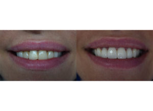 veneers1