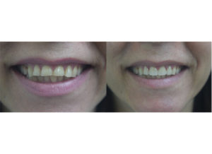veneers2