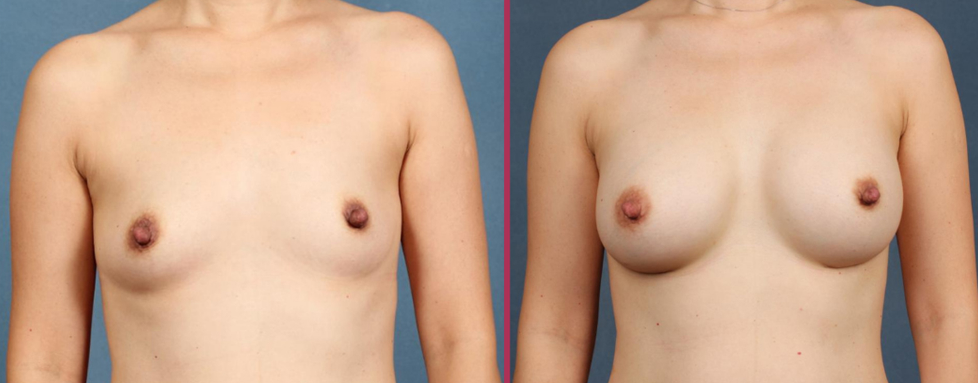 breast augmentation 05