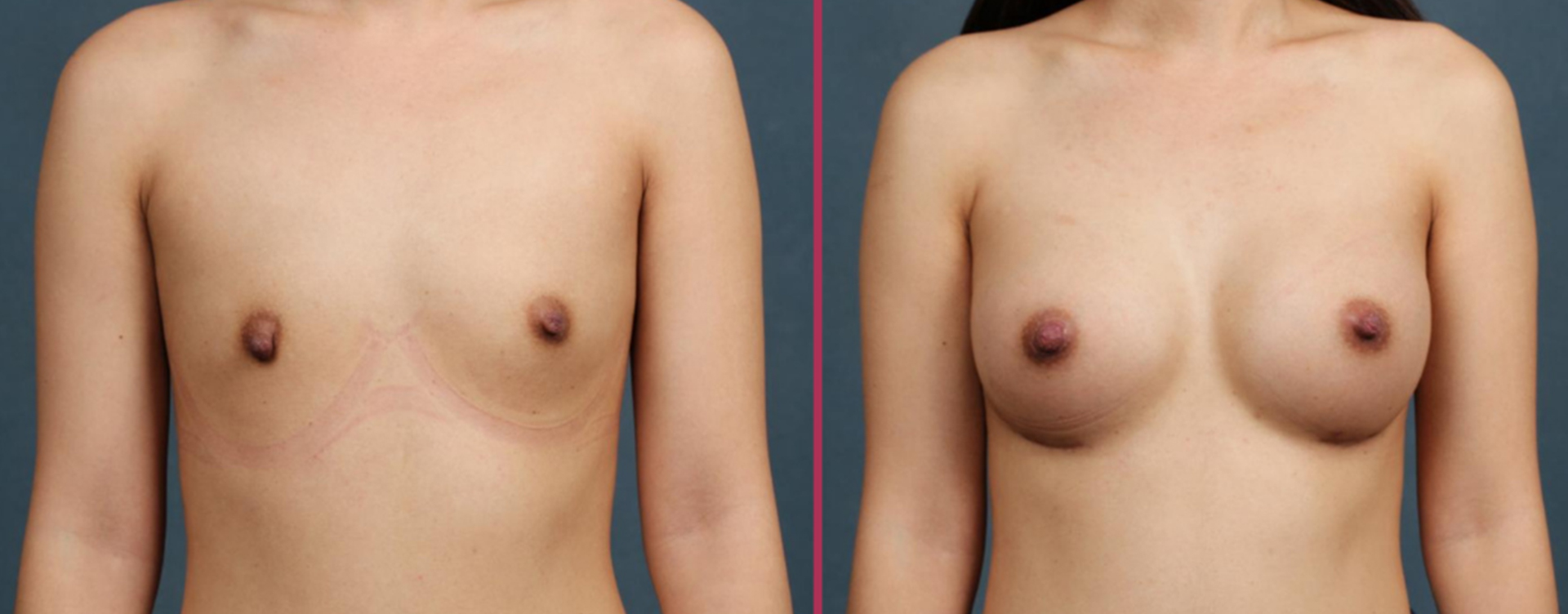 breast augmentation 06